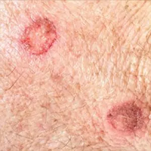 Keratosis Vanishing & Reoccuring: Condition that Requires Seborrheic Keratosis Treatment Keratosis Vanishing & Reoccuring: Condition that Requires Seborrheic Keratosis Treatment