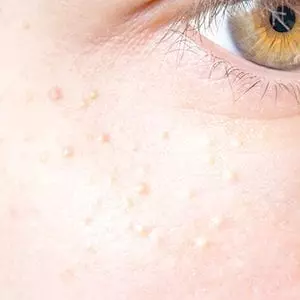 syringoma_thumbnail syringoma_thumbnail