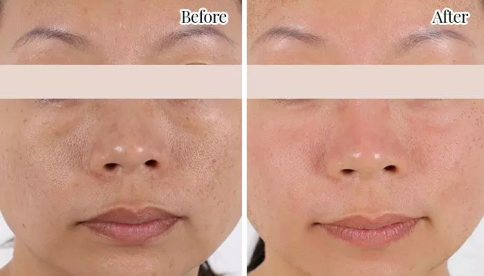 before-and-after-pigmentation3