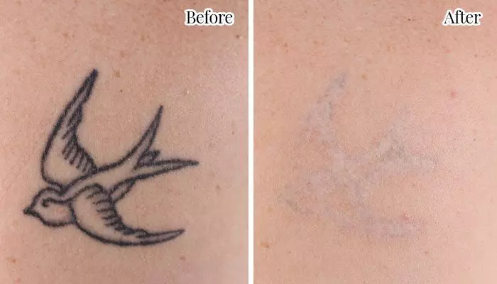 before-and-after-tattoo1
