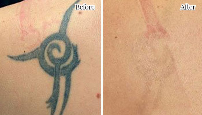 before-and-after-tattoo3
