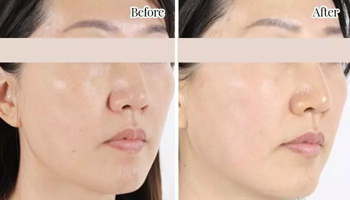 ultherapy non-surgical facelift and skin tightening before and after face