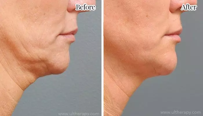 ultherapy non-surgical facelift and skin tightening before and after neck woman